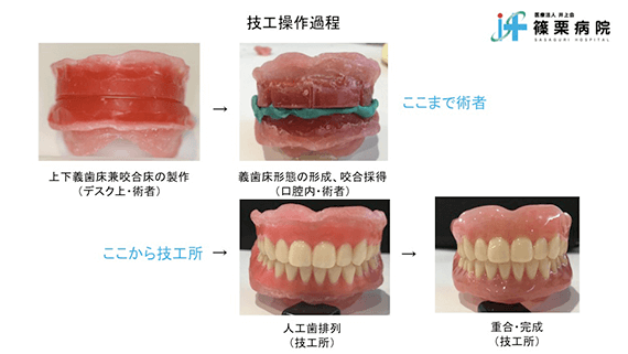 総義歯製作の新たな取り組み スライド画像04