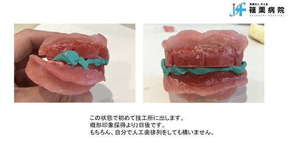 総義歯製作の新たな取り組み スライド画像09